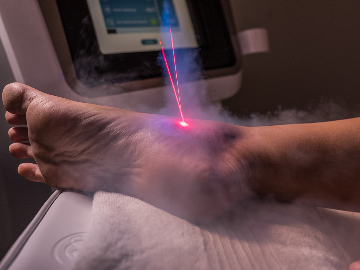 Recuperación muscular con crioterapia